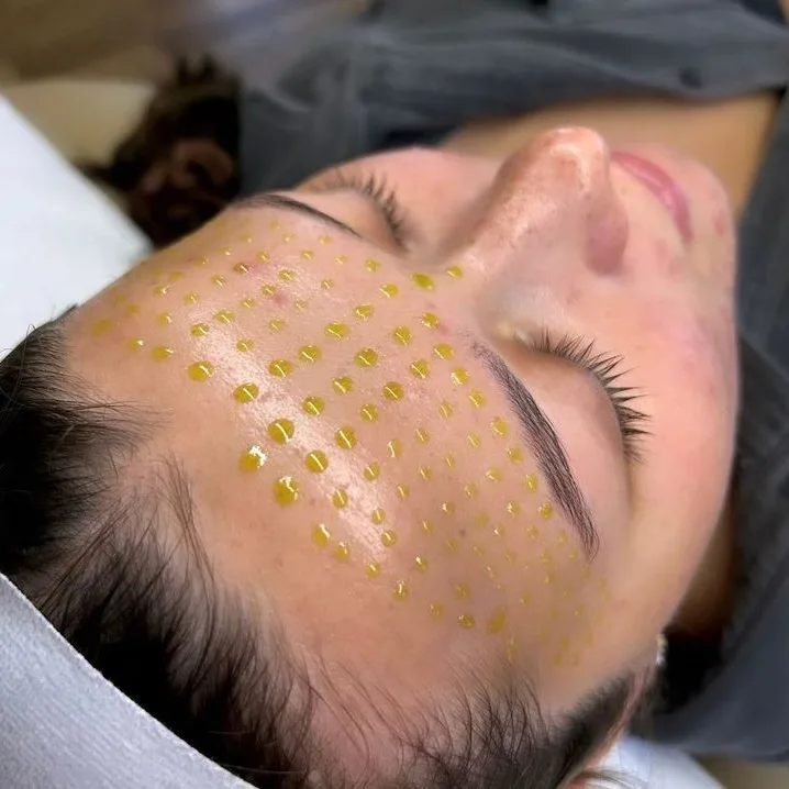 Peeling Renovador